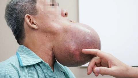 Người đàn ông nguy kịch vì khối u to bằng đầu sắp "nổ tung" dưới miệng