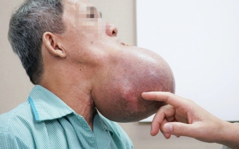 Người đàn ông nguy kịch vì khối u to bằng đầu sắp "nổ tung" dưới miệng