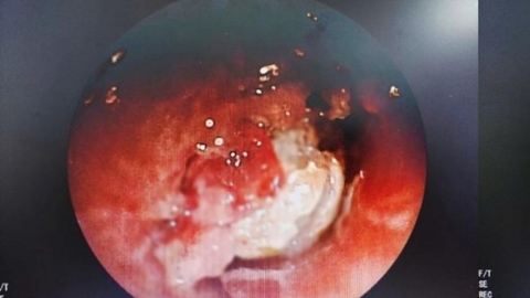 Ăn b&aacute;nh hạnh nh&acirc;n đậu phộng khi nằm v&otilde;ng, nam sinh bất ngờ nguy kịch