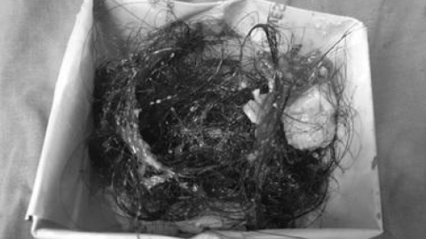 B&oacute;c u nang cho nữ bệnh nh&acirc;n, b&aacute;c sĩ ph&aacute;t hiện th&agrave;nh phần kỳ lạ