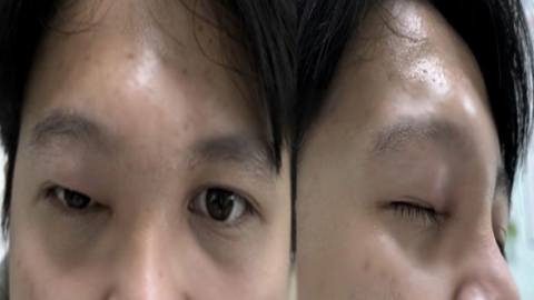Ch&agrave;ng trai bỗng bị hủy xương v&ugrave;ng mặt, su&yacute;t mất mạng sau khi chảy mũi đục