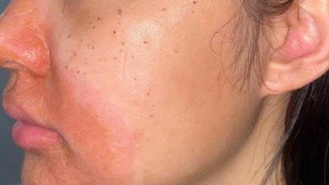 Cảnh b&aacute;o biến chứng vi&ecirc;m da tiếp x&uacute;c nặng sau peel da tại spa