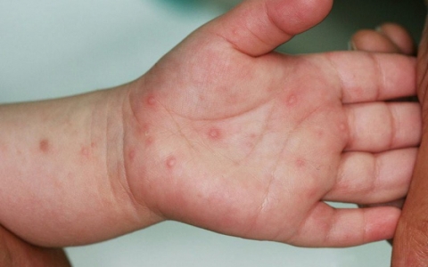 Dự b&aacute;o số ca mắc tay ch&acirc;n miệng nguy cơ gia tăng thời gian tới