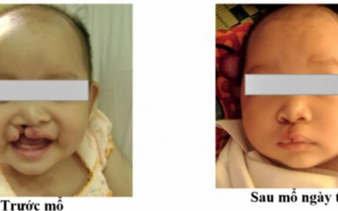 Nghệ An tiếp nhận viện trợ chăm s&oacute;c trẻ em bị dị tật khe hở m&ocirc;i, v&ograve;m miệng