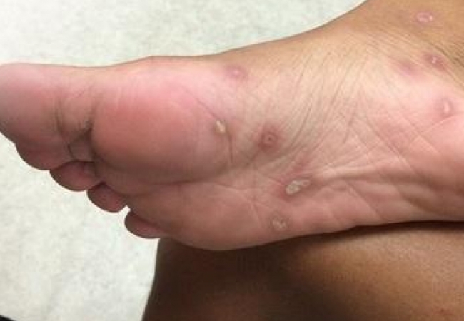 Gia tăng người mắc s&ugrave;i m&agrave;o g&agrave;, giang mai v&agrave;o bệnh viện cầu cứu