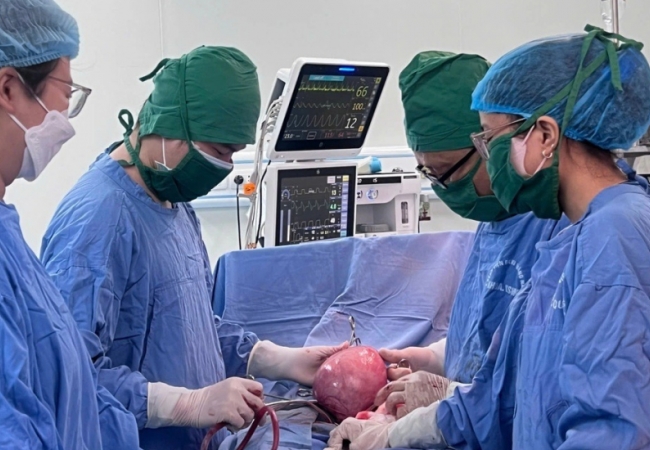 Người phụ nữ mang khối u xơ tử cung nặng 3kg, tương đương một thai nhi